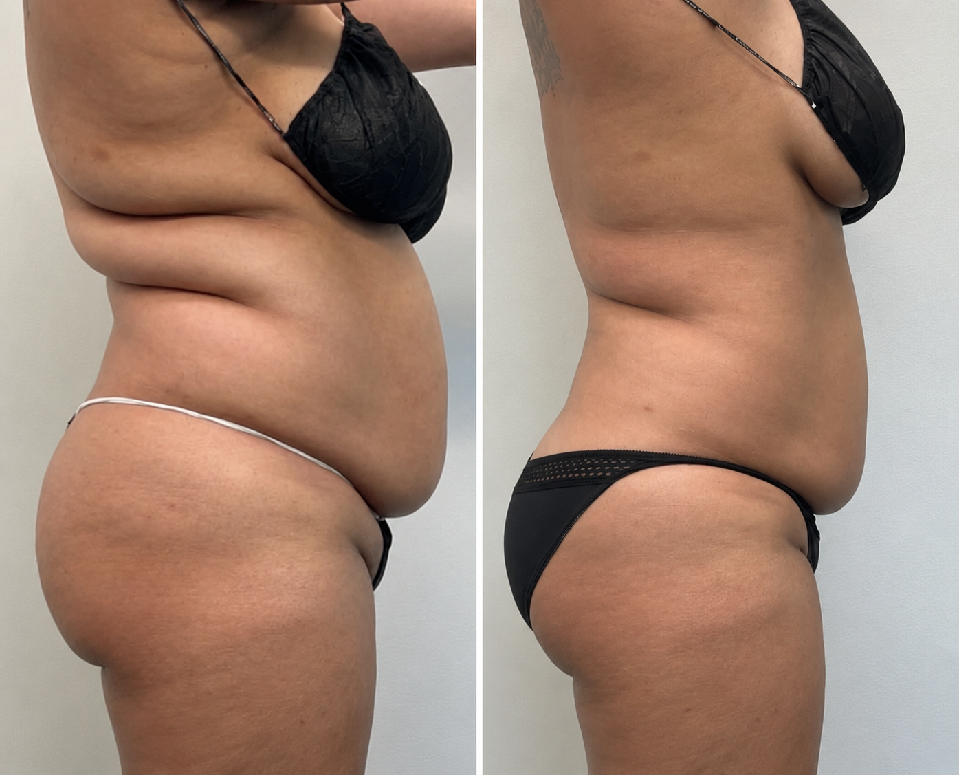 Before and after side-profile photographs of a Citrus & Sage client who completed InvisaRed sessions