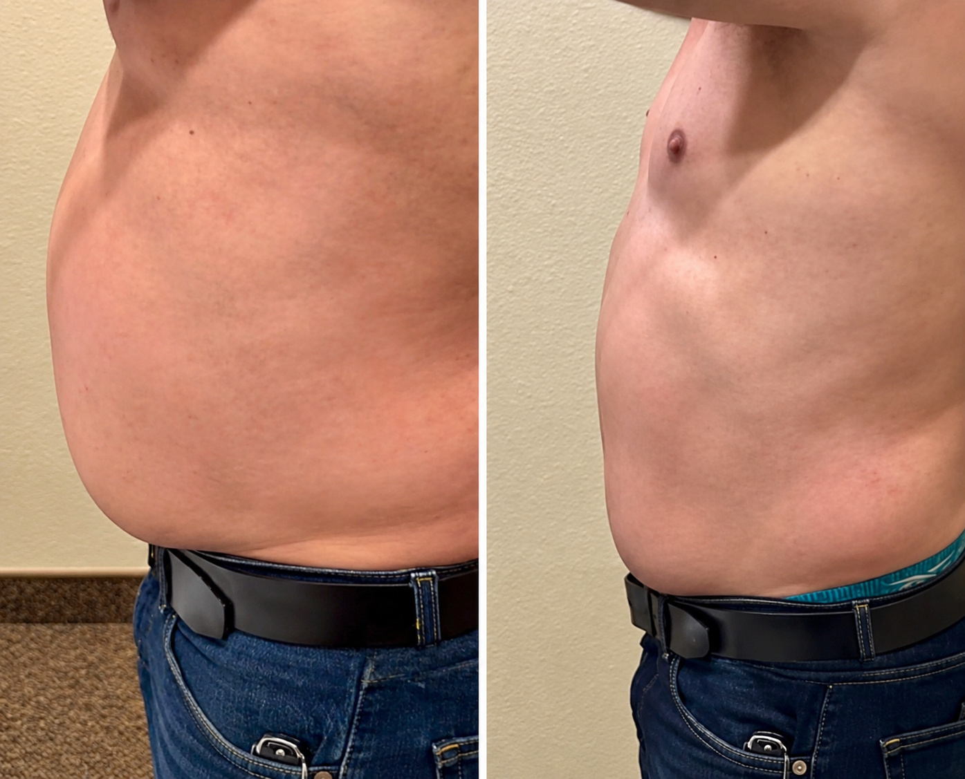 Before and after side-profile photographs of a second Citrus & Sage client who completed InvisaRed sessions