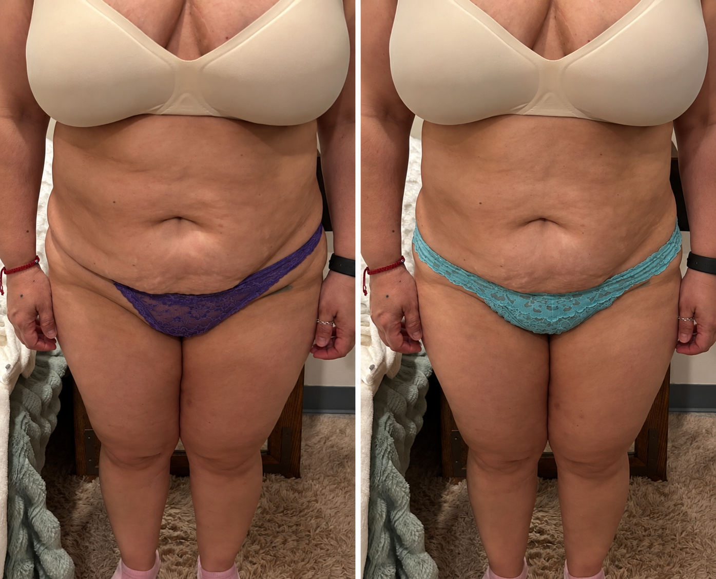 Before and after front-facing photographs of a third Citrus & Sage client who completed InvisaRed sessions